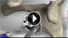 Animation zum Operationsverfahren Univers II Schulter-Totalendoprothese (externer Link)