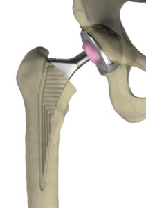 Darstellung einer implantierten totalen Hüftprothese mit Schaft, Pfanne und Kopf